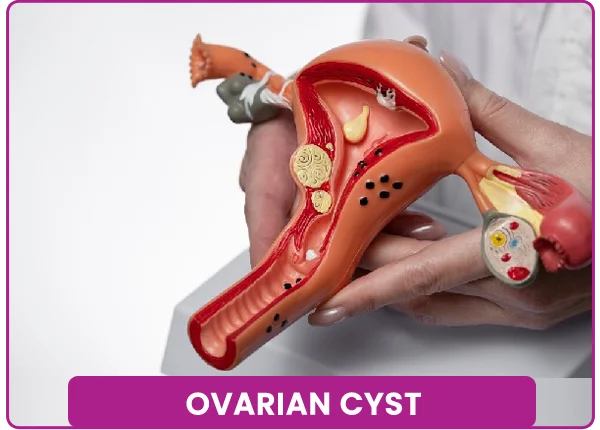 Ovarian Cyst
