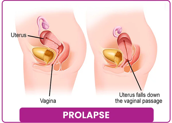 Prolapse